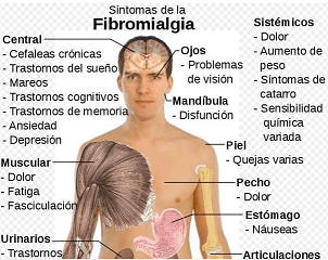 sintomas de la fibromialgia